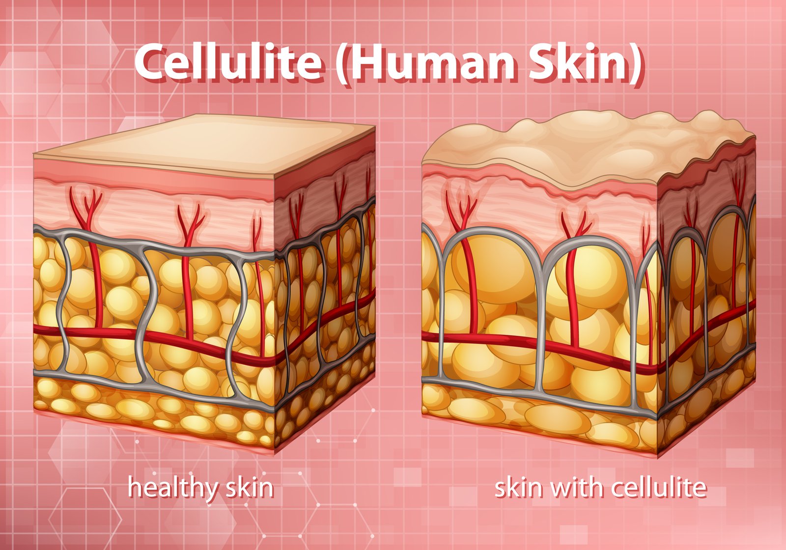 cellulitis/ cellulite problems